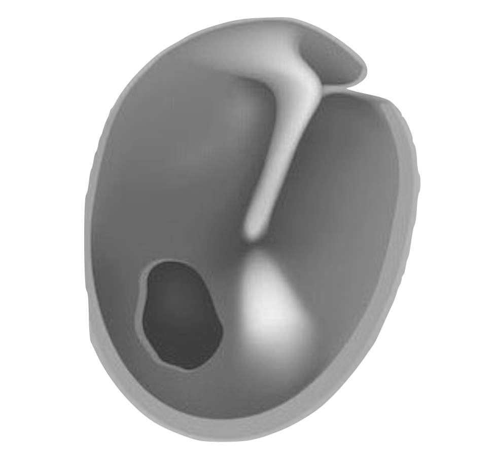 Tympanic Membrane Perforation